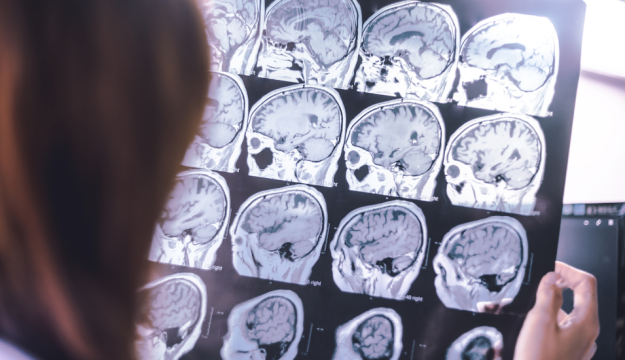 Learning more about the mysteries of dementia