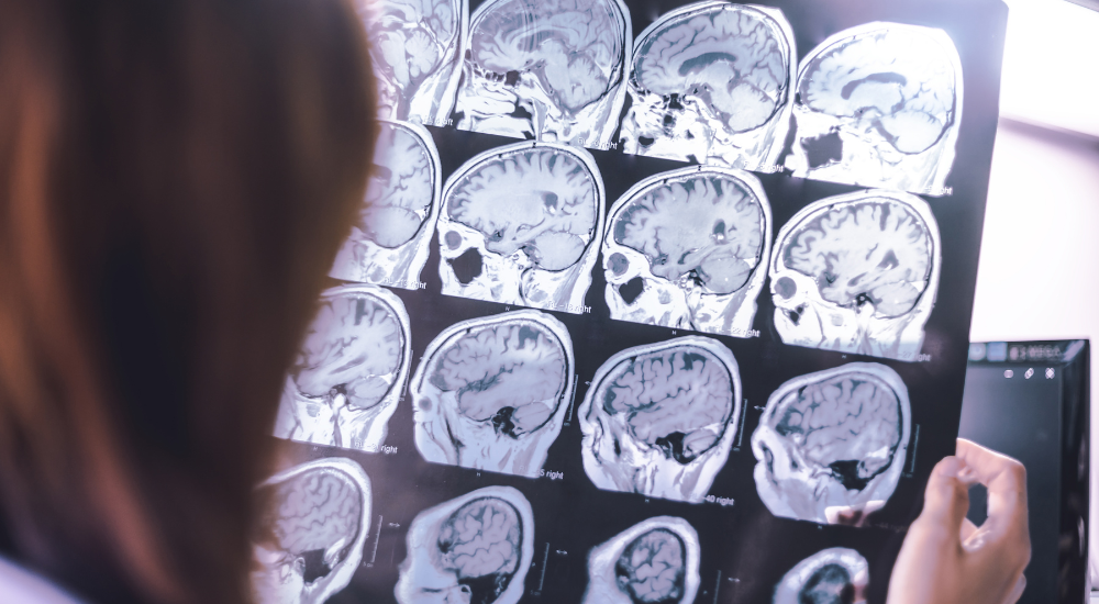 Learning more about the mysteries of dementia